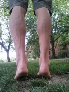 Right calf (clubfoot side) hypotrophy relative to left.
